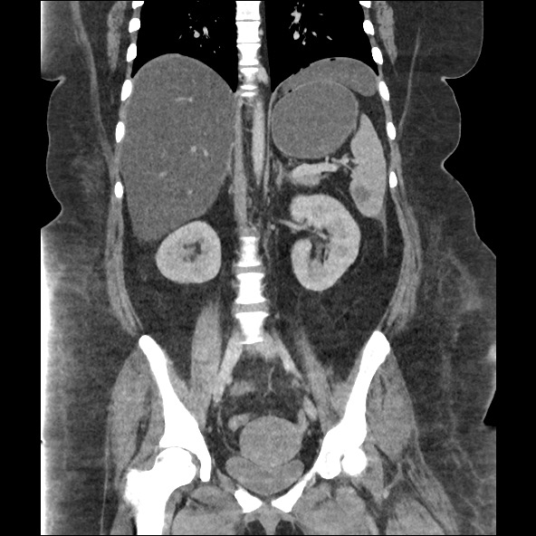 Bowel and splenic infarcts in acute lymphocytic leukemia (Radiopaedia 61055-68915 B 38).jpg