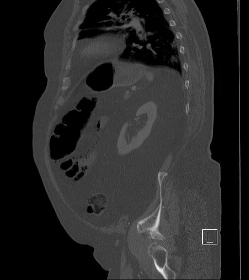 Bowel ischemia secondary to SMA occlusion with extensive portomesenteric venous gas (Radiopaedia 54656-60871 Sagittal bone window 27).jpg