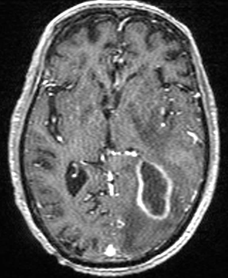 Brain abscess with dual rim sign (Radiopaedia 87566-103938 Axial T1 C+ 85).jpg