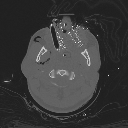 File:Brain contusions, internal carotid artery dissection and base of skull fracture (Radiopaedia 34089-35339 Axial bone window 30).png