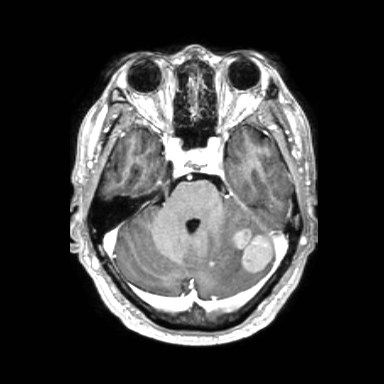 File:Brain metastases from lung cancer (Radiopaedia 83839-99028 Axial T1 C+ 16).jpg