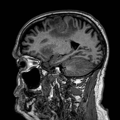 Brain metastases from lung cancer (Radiopaedia 83839-99028 Sagittal T1 85).jpg