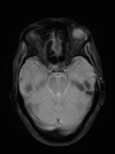 File:Brain metastasis as initial presentation of non-small cell lung cancer (Radiopaedia 65122-74126 Axial T2* 8).jpg