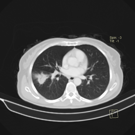 File:Brain metastasis as initial presentation of non-small cell lung cancer (Radiopaedia 65122-74127 Axial lung window 26).jpg