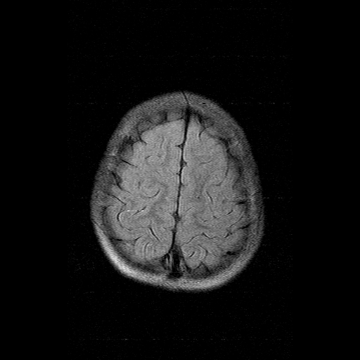 File:Brainstem ganglioglioma (Radiopaedia 10763-11224 Axial FLAIR 3).jpg