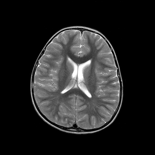 File:Brainstem ganglioglioma (Radiopaedia 10763-11224 Axial T2 8).jpg