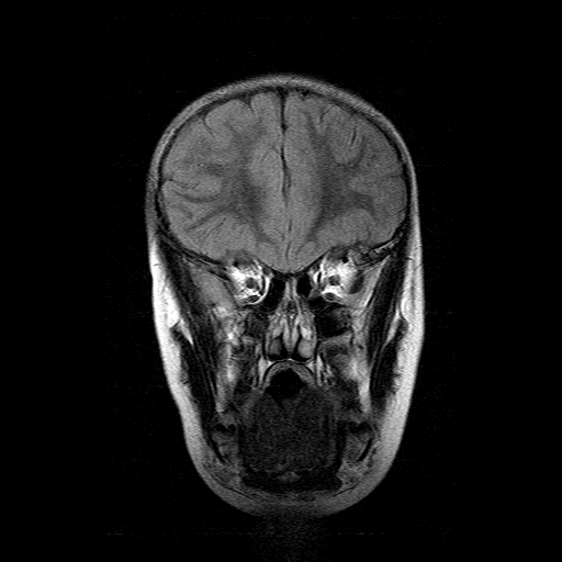 File:Brainstem ganglioglioma (Radiopaedia 10763-11224 Coronal FLAIR 15).jpg