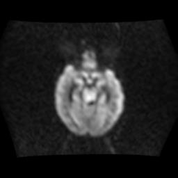 File:Brainstem glioma (Radiopaedia 30923-31624 Axial DWI 8).jpg