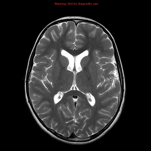 File:Brainstem glioma (Radiopaedia 9444-10124 Axial T2 12).jpg