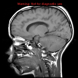 File:Brainstem glioma (Radiopaedia 9444-10124 Sagittal T1 3).jpg