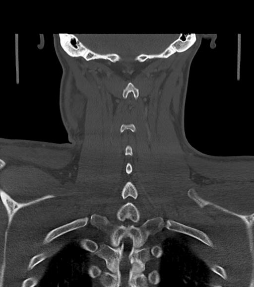 Branchial cleft cyst (Radiopaedia 31167-31875 Coronal bone window 50).jpg