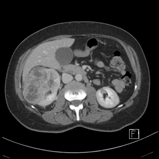 Breast metastases from renal cell cancer (Radiopaedia 79220-92225 C 42).jpg