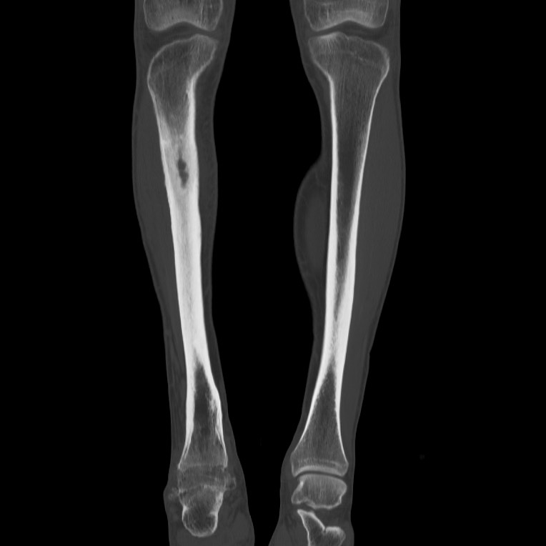 Brodie abscess - tibia (Radiopaedia 66028-75204 Coronal bone window 14).jpg