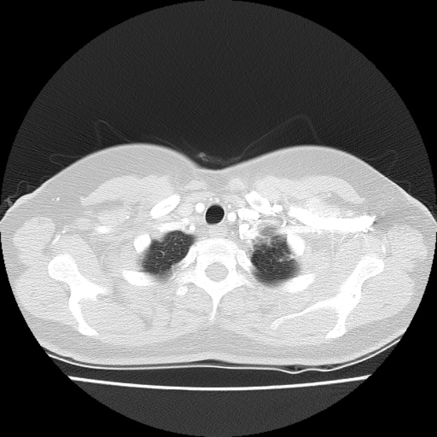 Bronchial atresia (Radiopaedia 22965-22992 Axial lung window 47).jpg