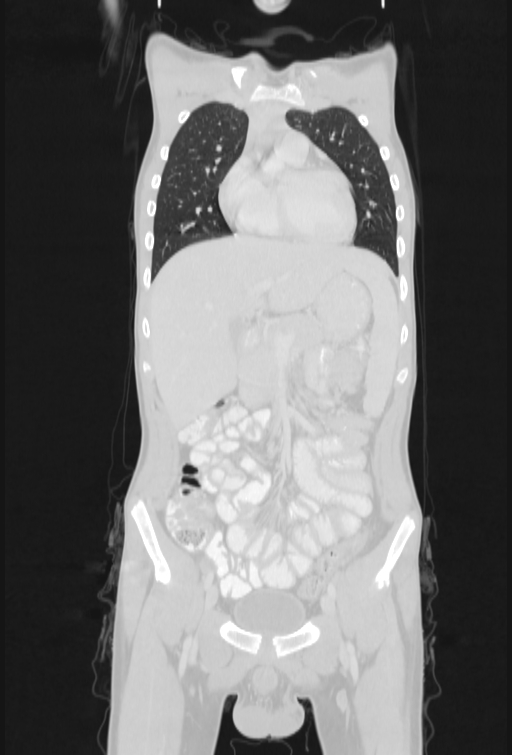Bronchial carcinoid tumor (Radiopaedia 57187-64090 Coronal lung window 27).jpg