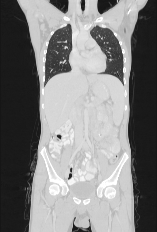 Bronchial carcinoid tumor (Radiopaedia 57187-64090 Coronal lung window 38).jpg