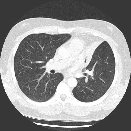 Bronchial carcinoid tumor (Radiopaedia 67377-76764 Axial lung window 31).jpg