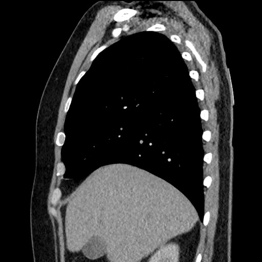 Bronchial carcinoid tumor (Radiopaedia 67377-76764 E 18).jpg