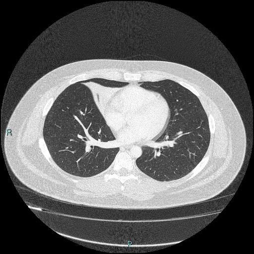 Bronchial carcinoid tumor (Radiopaedia 78272-90875 Axial lung window 30).jpg