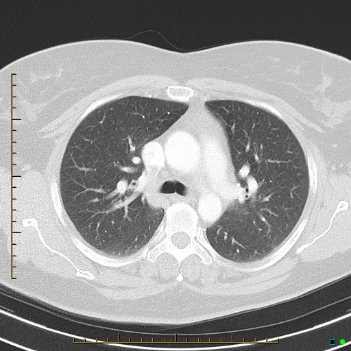 File:Bronchial diverticula (Radiopaedia 79512-92675 Axial lung window 18).jpg