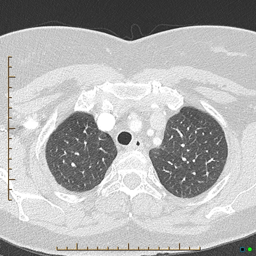 Bronchial diverticula (Radiopaedia 79512-92676 Axial lung window 25).jpg