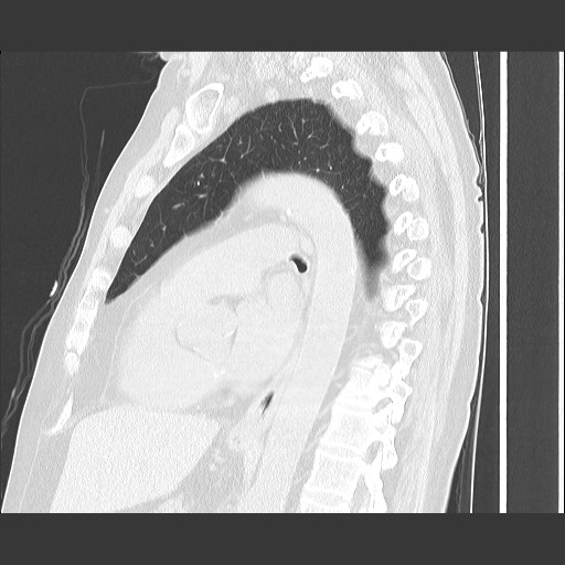 Bronchial stenosis - lung transplant (Radiopaedia 73133-83848 Sagittal lung window 40).jpg
