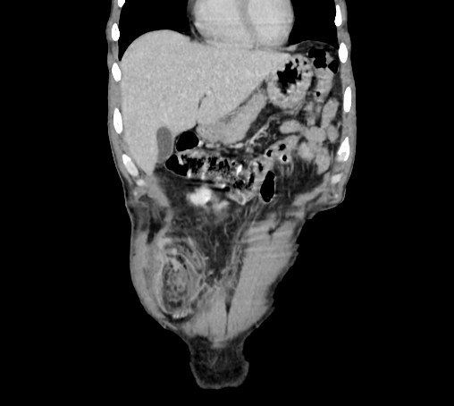 File:Bronchiectasis in Crohn disease (Radiopaedia 60311-67977 C 16).jpg