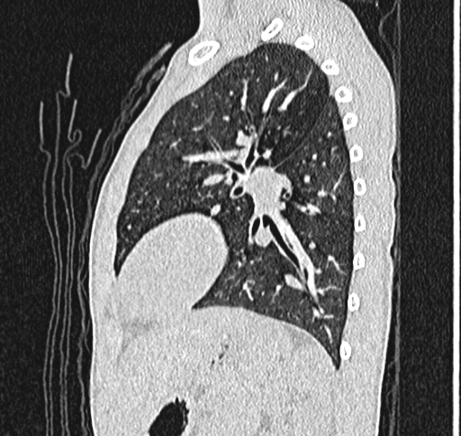 File:Bronchiolitis obliterans (Radiopaedia 71538-81897 Sagittal lung window 48).jpg