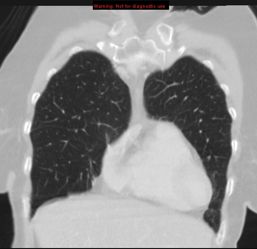 Bronchoalveolar carcinoma (BAC) (Radiopaedia 13436-13392 Coronal lung window 14).jpg