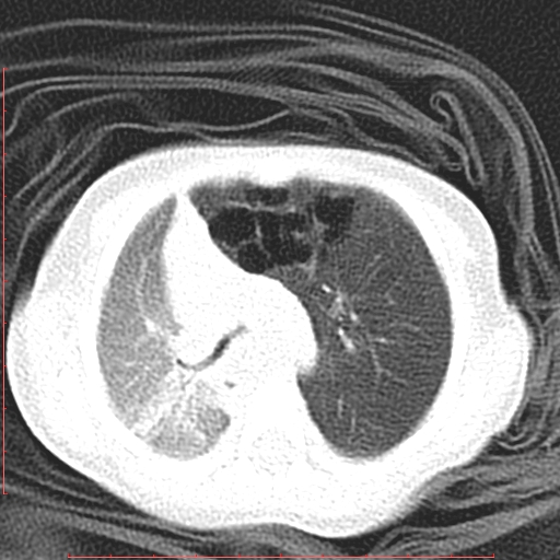 Bronchogenic cyst (Radiopaedia 78599-91409 Axial lung window 54).jpg