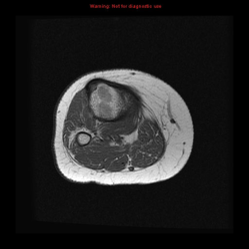 File:Brown tumor (Radiopaedia 12318-12597 Axial T1 15).jpg