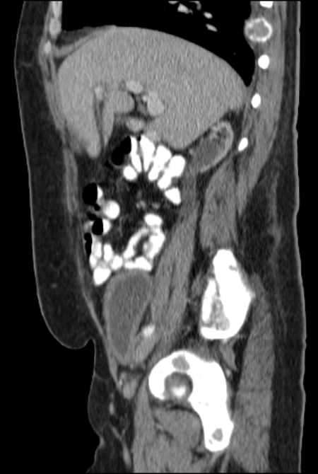 Brown tumors compressing the spinal cord (Radiopaedia 68442-77988 F 20).jpg