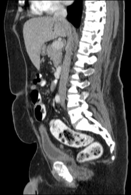 Brown tumors compressing the spinal cord (Radiopaedia 68442-77988 F 27).jpg