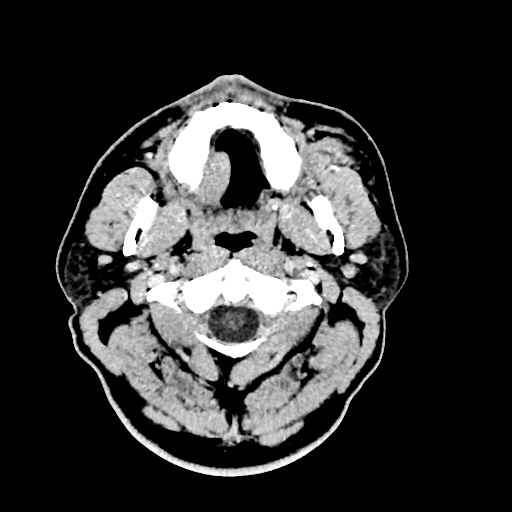 Buccal fat pad arteriovenous malformation (Radiopaedia 70936-81142 Axial non-contrast 25).jpg