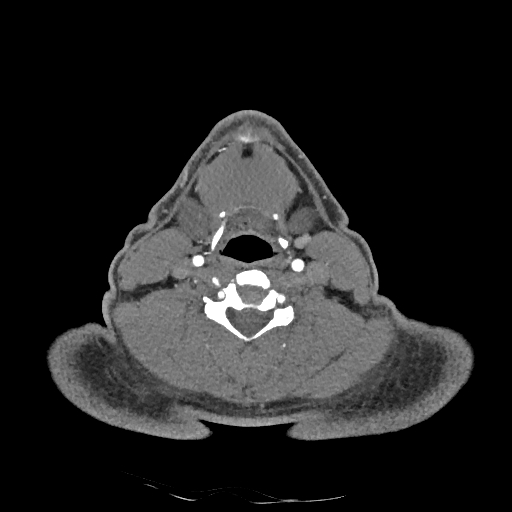 Buccal fat pad arteriovenous malformation (Radiopaedia 70936-81144 D 127).jpg