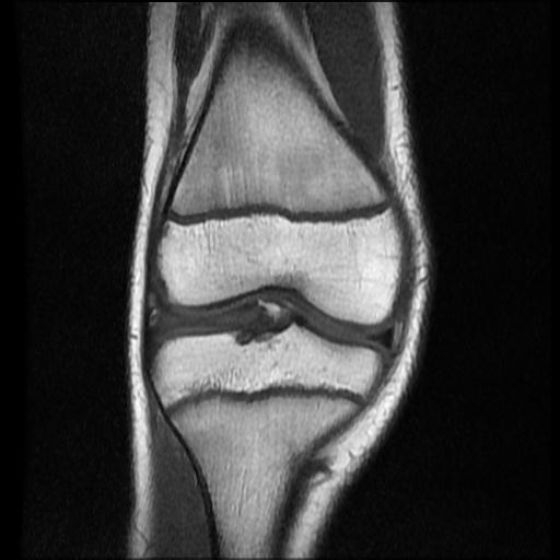 File:Bucket handle tear - lateral meniscus (Radiopaedia 72124-82634 Coronal T1 7).jpg
