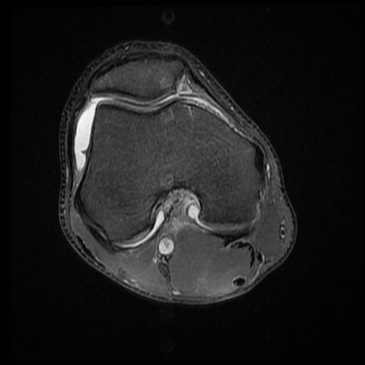 File:Bucket handle tear - medial meniscus (Radiopaedia 69245-79026 Axial PD fat sat 7).jpg
