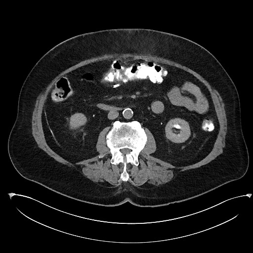 Buried bumper syndrome - gastrostomy tube (Radiopaedia 63843-72577 Axial Inject 54).jpg