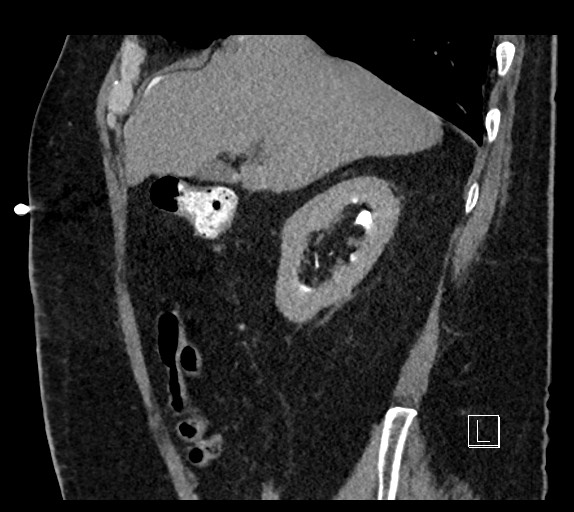 Buried bumper syndrome - gastrostomy tube (Radiopaedia 63843-72577 Sagittal Inject 87).jpg