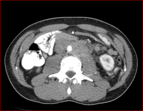 File:Burned-out testicular choriocarcinoma (Radiopaedia 32822-34040 B 12).PNG