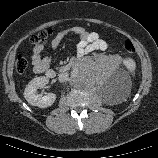 Burned-out testicular seminoma - retroperitoneal nodal metastases (Radiopaedia 62872-71245 A 33).jpg
