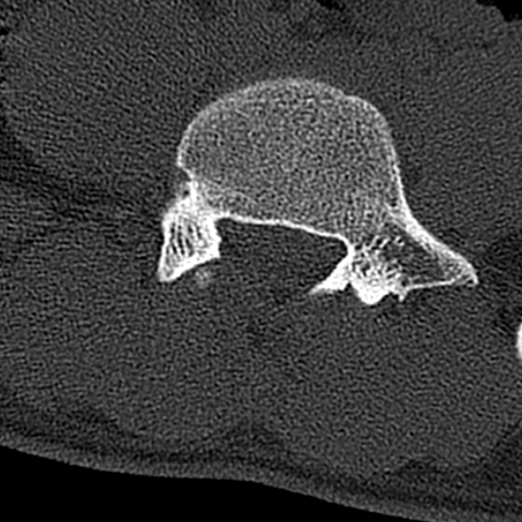 File:Burst fracture (Radiopaedia 53373-59357 Axial bone window 56).jpg