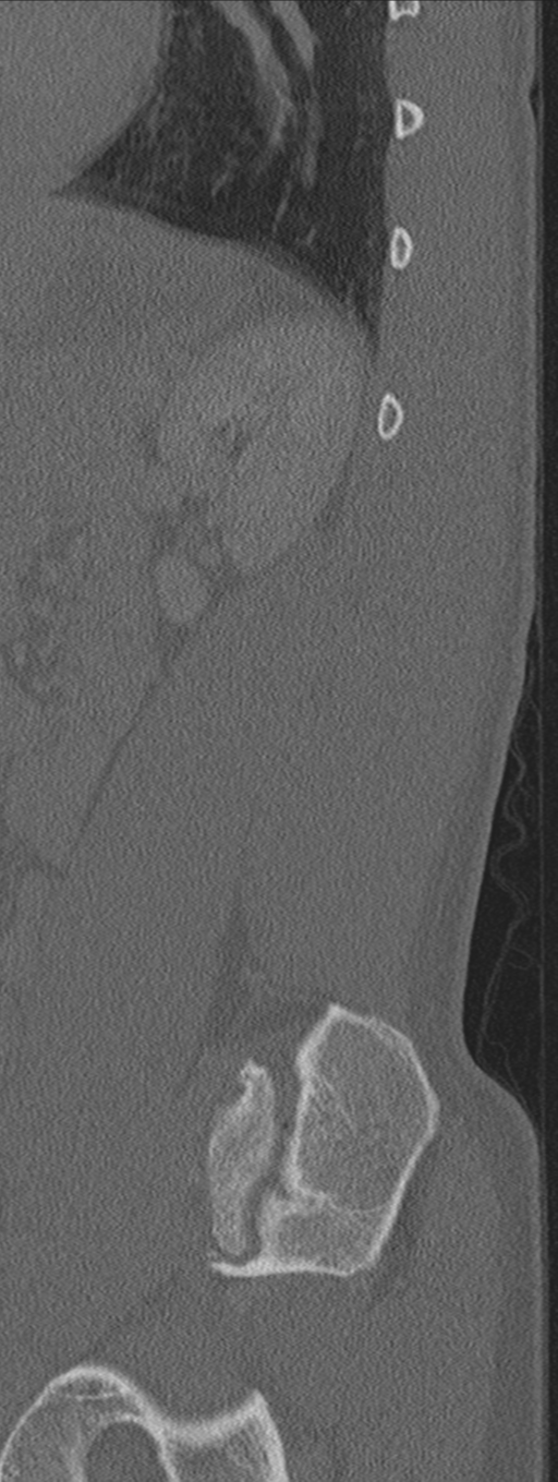 Burst fracture - T12 with conus compression (Radiopaedia 56825-63647 Sagittal bone window 11).png