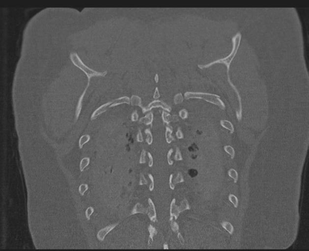 Burst fracture - thoracic spine (Radiopaedia 30238-30865 Coronal bone window 138).jpg