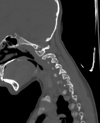 File:Butterfly vertebra (Radiopaedia 77903-90209 Sagittal bone window 17).jpg
