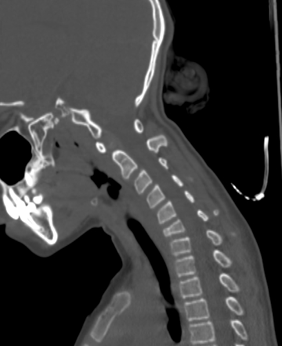 File:Butterfly vertebra (Radiopaedia 77903-90209 Sagittal bone window 58).jpg