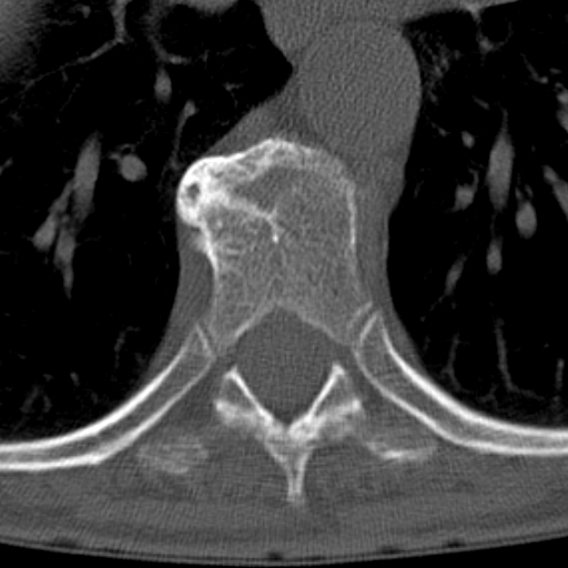 Butterfly vertebrae with kyphoscoliosis (Radiopaedia 14257-14133 Axial bone window 22).jpg