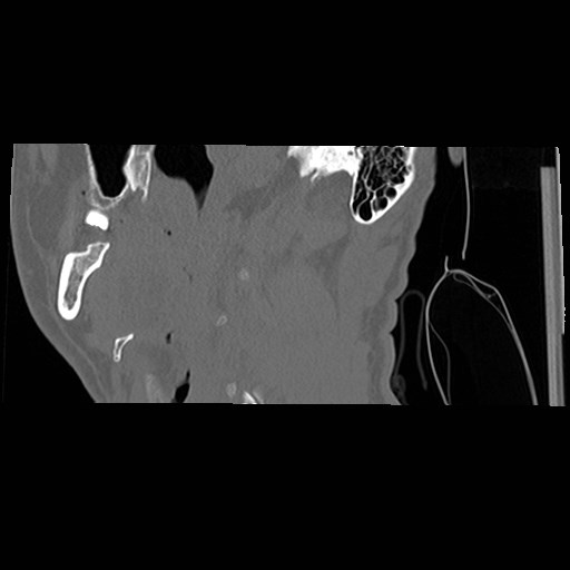 C1-C2 "subluxation" - normal cervical anatomy at maximum head rotation (Radiopaedia 42483-45607 C 62).jpg