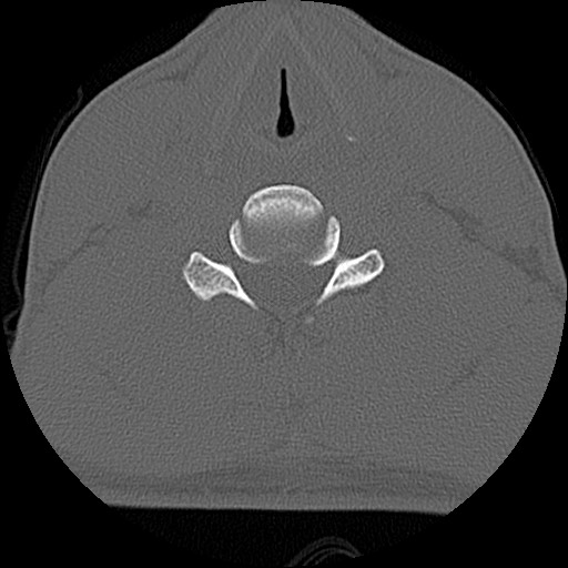 File:C5 facet fracture (Radiopaedia 58374-65499 Axial bone window 58).jpg