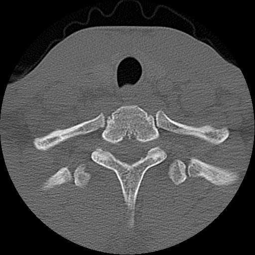 File:C5 facet fracture (Radiopaedia 58374-65499 Axial bone window 82).jpg